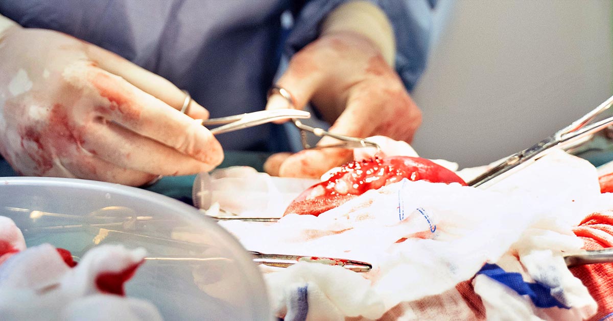 Keeping abdomen sterile during surgery.