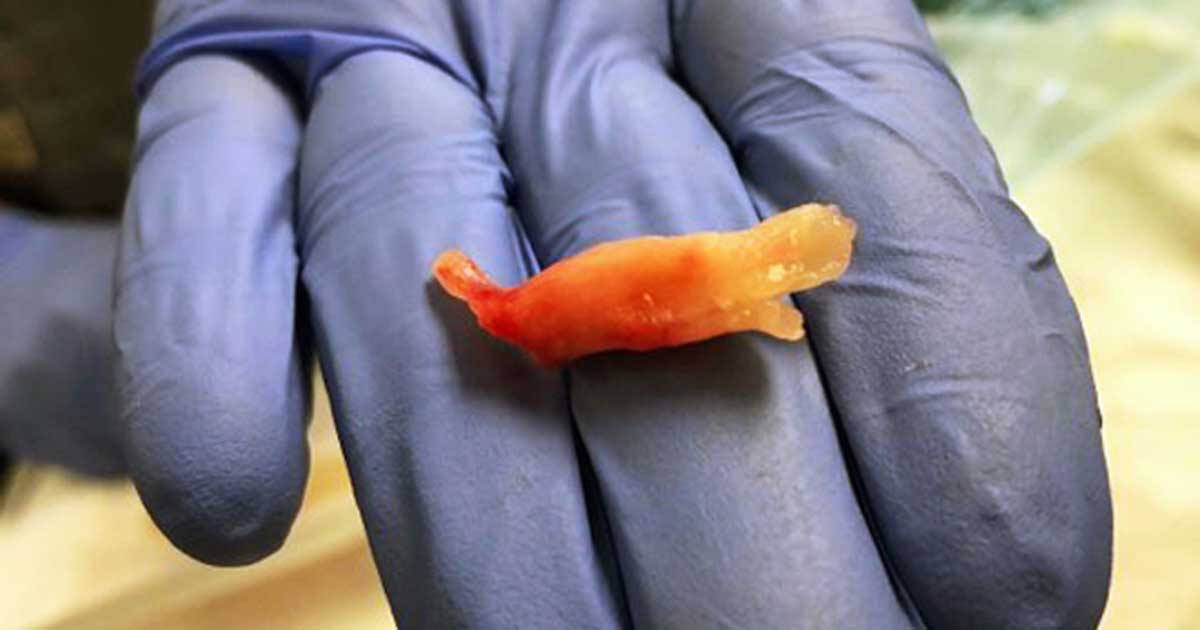 Figure 1. The obstructive fibrinous tracheal pseudomembrane was removed in one piece.