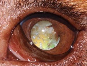 Figures 3a-3d. States of progression. 3d. Hypermature: resorption of lens fibres; wrinkled lens capsule; capsule plaques; tapetal reflex can be partially seen; regain of vision possible in some cases, hyperopic (farsighted).