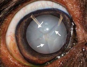 Figure 4. Diabetic cataract. Note the typical waterclefts along the sutures lines.
