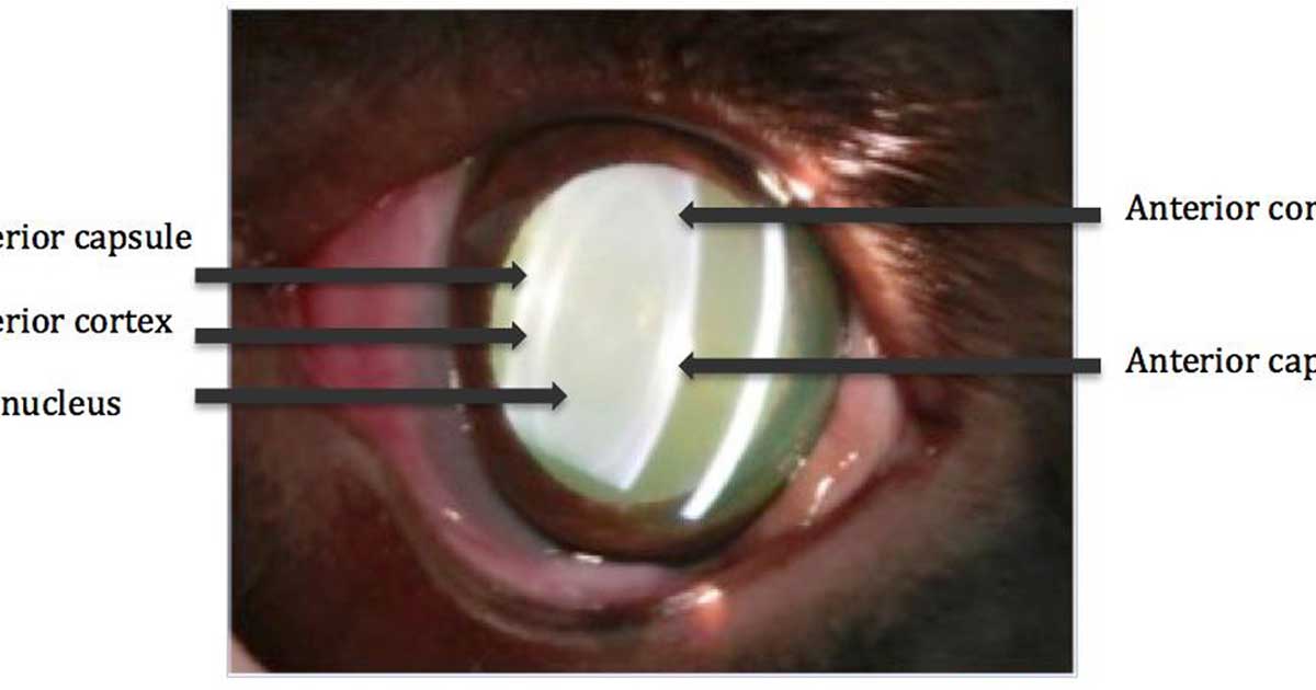 Figure 1. A slit lamp image of a lens showing the capsule, cortex and nucleus.