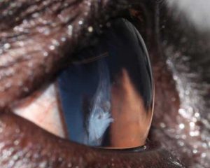 Figure 6b. Lens opacity along the posterior sutures lines caused by a blunt trauma. Also note the subconjunctival haemorrhages.