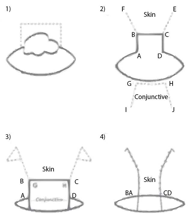 Figure 9. A diagram of a sliding skin graft advancement flap combined with a conjunctival advancement.