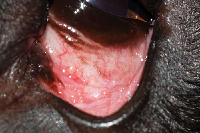 Figure 4. Left eye follicular conjunctivitis and deep-medial canthal pocket syndrome in a nine-month-old flat-coated retriever.