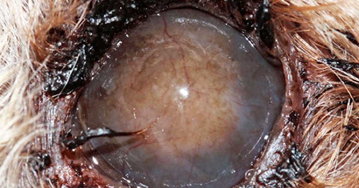 Figure 1. A patient with blepharitis and keratitis related to severe keratoconjunctivtis sicca. Note the dark crusty ocular discharge, corneal fibrosis, pigmentation and vascularisation. Cataract surgery was not feasible due to the corneal pathology in this patient.