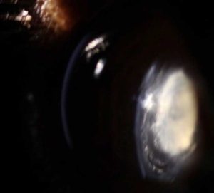 Figure 5. (5a) Slit lamp image of an immature cataract with diffuse opacities in the lens cortex and a dense nucleus. (5b) Slit lamp image of a mature cataract. (5c) Slit lamp image of a hypermature cataract. Note the irrgular anterior lens capsule.