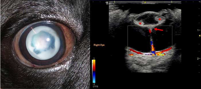 Figure 11. Persistent hyaloid artery (PHA). 11a. On direct examination, the cataractous changes within this patient’s right eye can be seen. 11b. A B-mode ultrasound of the same patient shows reduction in lens volume, with cortical cataractous changes visible as echogenic areas within the normally anechoic lens (asterisks). A PHA is present a retrolenticular plaque can be seen at the attachment of the PHA to the posterior lens (red arrow). This image also shows the use of Doppler ultrasonography with coloured pixels representing vascular flow within the PHA and the choroid.
