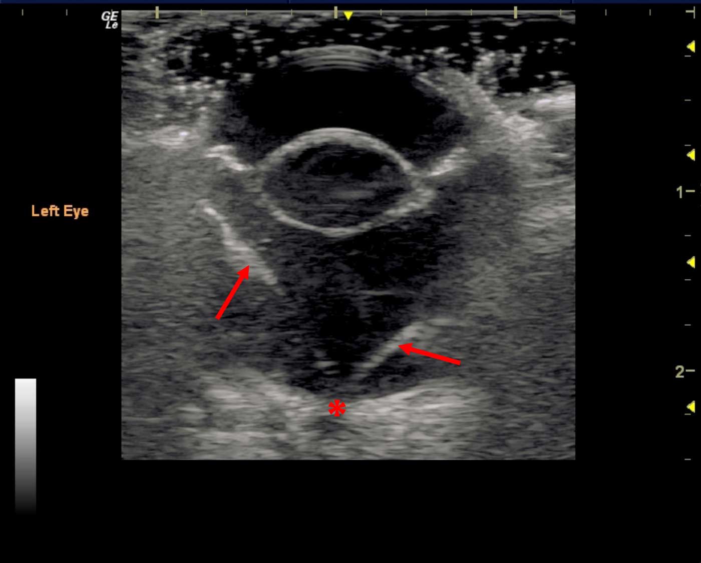 Figure 13. Total retinal detachment. This image shows the classic “V” shape formed by detached retinal membranes (red arrows). The attachment at the optic disc can still be seen (asterisk) and may help to differentiate a retinal detachment from a posterior vitreal detachment.