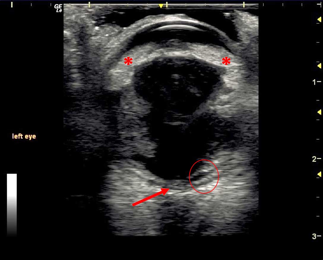 Figure 14. This B-mode ultrasound image shows the left eye of a patient that had panuveitis secondary to fulminant disseminated fungal infection. The Iris and ciliary body are thickened and irregular (asterisks), and the optic disc has become swollen and hypoechoic (red arrow). Within the area denoted by the red circle, the normally combined appearance of the posterior tissue layers has been lost. From anterior to posterior, the layers seen are: the echogenic interface of the detached retina, an anechoic area of subretinal oedema, a thickened choroid with a band of hypoechoic choroidal oedema, and the scleral layer.