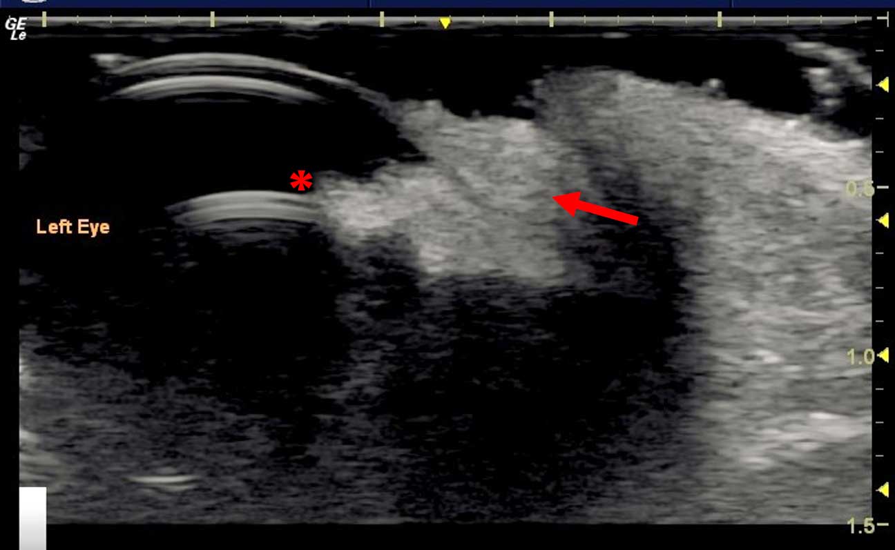 Figure 15. Invasive ocular neoplasia. An irregular heterogenous mass (red arrow) can be seen extending from the corneal limbus into the anterior chamber and anterior lens capsule (asterisk).