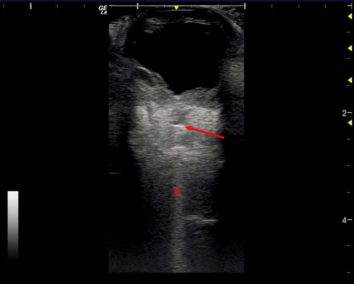 Figure 16. Retrobulbar foreign body. A linear hyperechoic structure representing a foreign body is present within the retrobulbar space (red arrow). The dense foreign material is creating a distal reverberation artefact (asterisk) and the surrounding retrobulbar tissues are inflamed, appearing more hyperechoic and irregular.