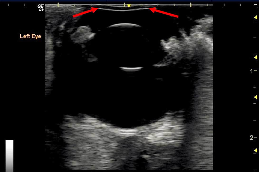 Figure 3. In this image, direct pressure from the probe placement on the cornea has caused the normally convex cornea to flatten (between arrows). This can be avoided by the liberal use of sterile acoustic gel.