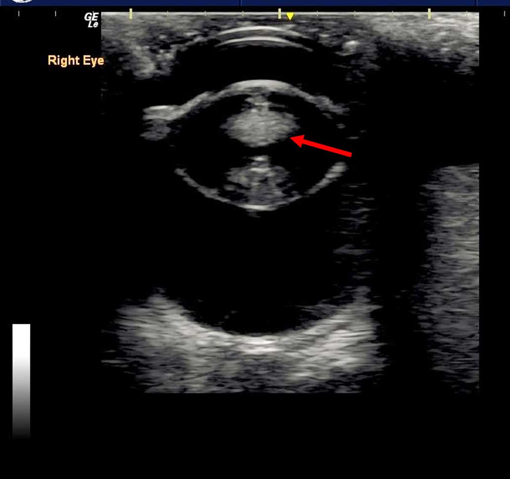 Figure 6. In this image of the right eye, the central portion of the normally anechoic lens has become echogenic, indicating the presence of a cataract (red arrow).