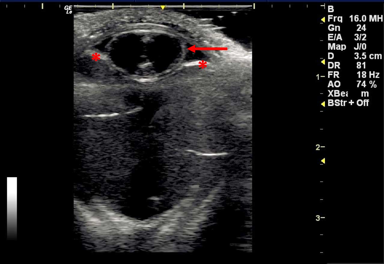 Figure 7. Anterior lens luxation. The lens is located within the anterior chamber (red arrow) anterior to the iris (asterisks).