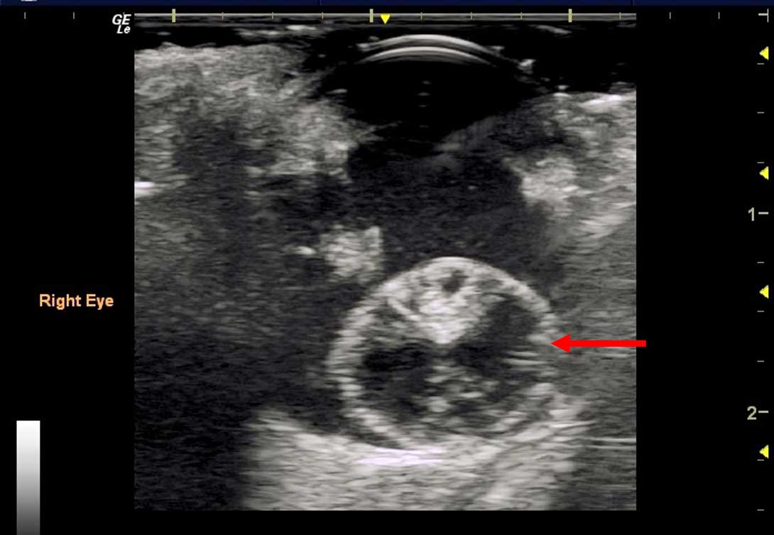 Figure 8. This image shows a patient with posterior lens luxation. The lens is located within the posterior vitreous chamber (red arrow). The surrounding vitreous contains echogenic material due to haemorrhage and inflammation.
