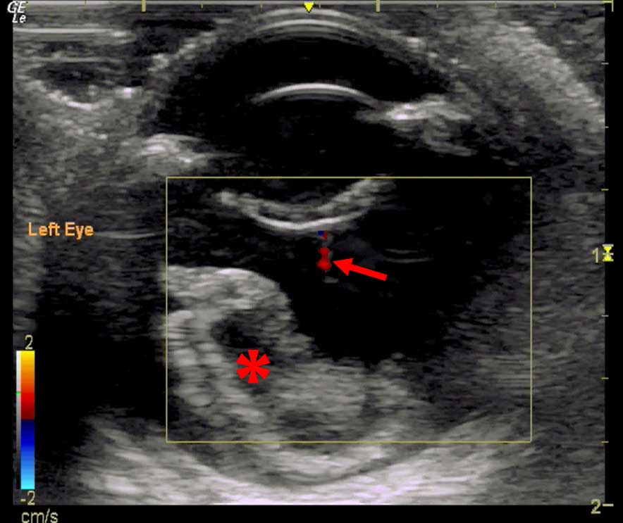 Figure 12. Persistent hyaloid artery and haemorrhage. This ultrasound image shows the left eye of a patient with a persistent hyaloid artery. The Doppler shift from vascular flow within the artery is shown by the red pixels (red arrow) indicating flow towards the ultrasound transducer. An organised clot is present within the vitreous chamber (*), which is not registering any vascular flow within the colour Doppler sample gate (yellow square).