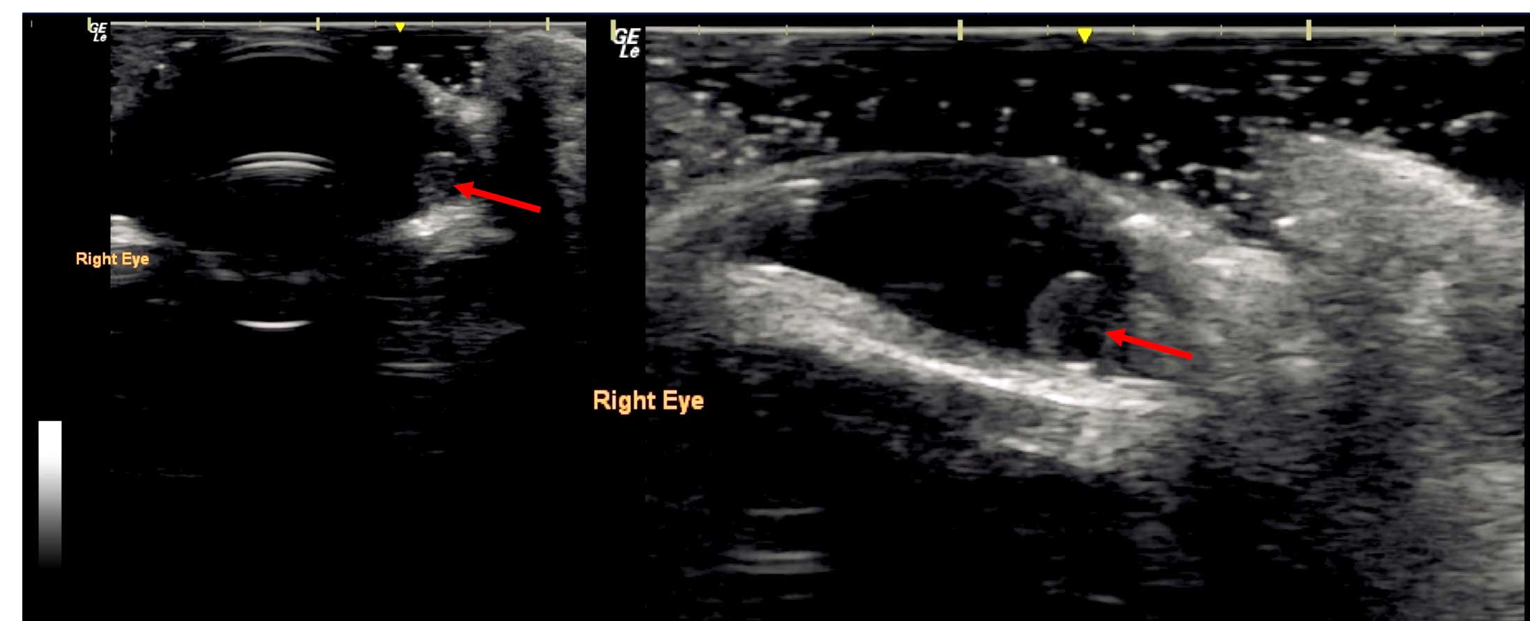 Figure 5. Iridociliary cysts. 5a. An iridociliary cyst can be seen within the anterior chamber (red arrow). 5b. In this enlarged image of the cyst (red arrow), the thin echogenic wall and an anechoic central area can be seen.