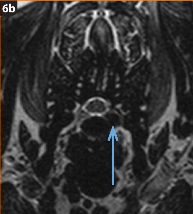 Hansen Types Genetics of disc disease in chondrodystrophic dogs
