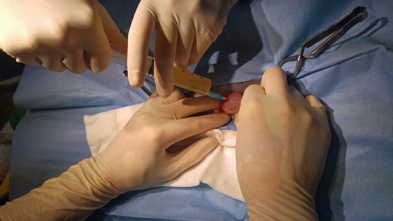 Drainage of the pseudocyst.
