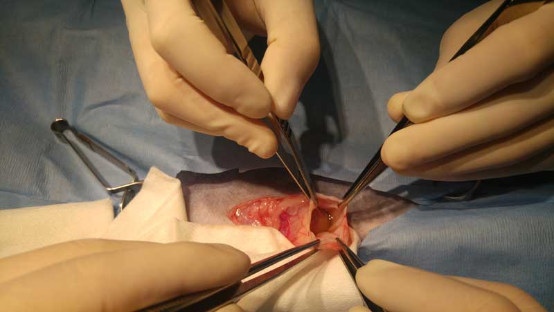 Resection of the pseudocyst capsule.