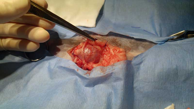 Omentalisation of the pseudocyst.