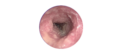 Ear canal