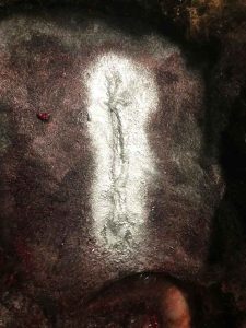 Figure 4. Location of the closed surgical site relative to the clip patch.