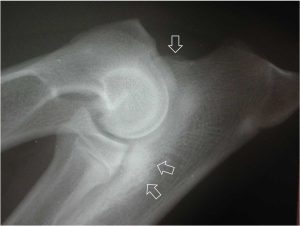 Figure 6b. An abnormal elbow joint with mild osteophytosis of the proximal border of the anconeal process (single arrow) and subtrochlear sclerosis (double arrows).