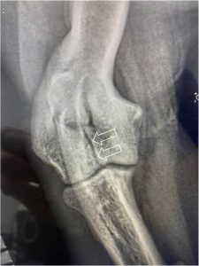 Figure 7. Humeral intracondylar fissure (HIF; arrows) in a five-year-old springer spaniel. The dog had presented with contralateral lateral condylar fracture and this HIF lesion was discovered as an incidental finding. HIF can cause pain and lameness in its own right, and is a risk factor for complete condylar fractures. HIF is often not apparent on plain radiographs and CT is the preferred diagnostic.