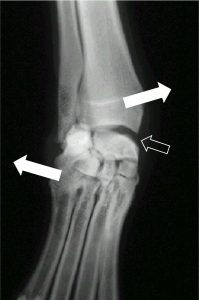 Figure 8a. Stressed radiograph demonstrating failure of the medial collateral ligament of the carpus.