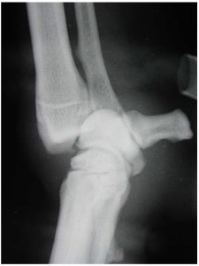 Figure 8b. Luxation of the antebrachiocarpal joint.