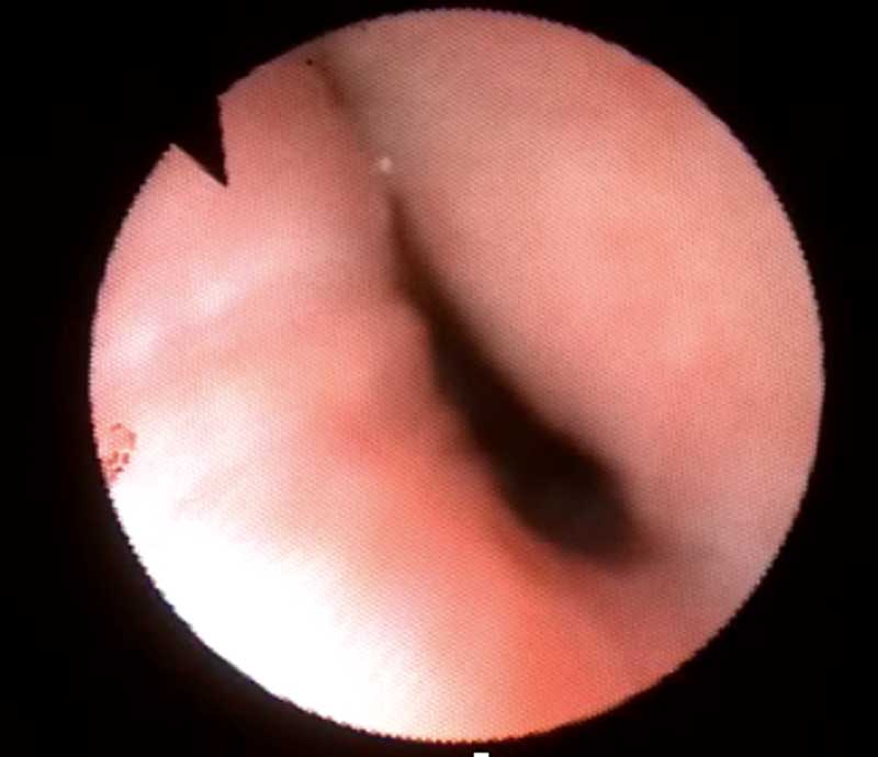 Figure 1b. Bronchoscopy image visualising the view from just distal to the carina with left mainstem bronchial collapse.