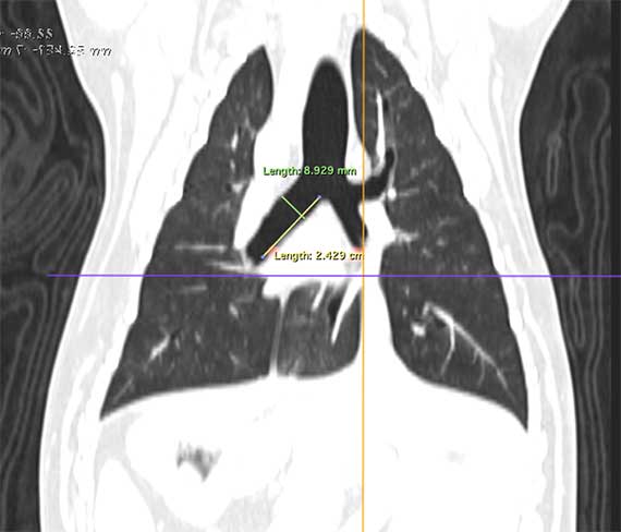 Figure 2. This image demonstrates how CT is used to measure the area of collapsed bronchus to allow calculation of appropriately sized stent.