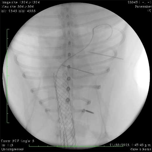 Figure 3. A bronchial stent placed over a guide wire, visualised with fluoroscopy.