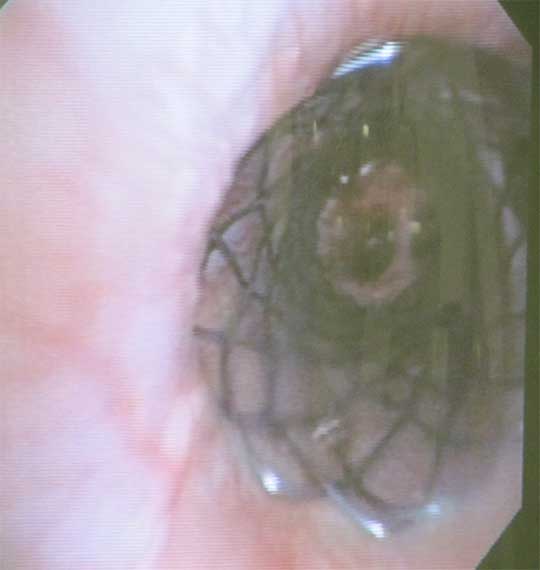 Figure 4. A bronchial stent correctly placed into the left bronchus, visualised via bronchoscopy.