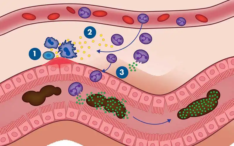 Figure 1. Mechanism of faecal calprotectin release during gastrointestinal inflammation. 1. Immune responses are stimulated. 2. Release of inflammatory cytokines. 3. Neutrophil disintegration results in calprotectin release into the gut lumen.