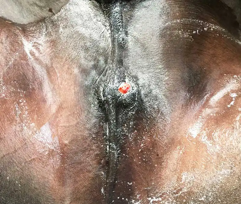 Figure 2. Chronic discharging sinus from the scrotum.