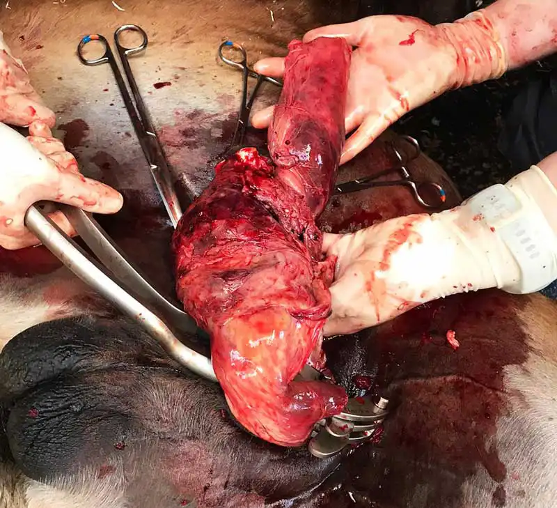 Figure 3. Intraoperative photo showing the extent of a severe scirrhous cord.