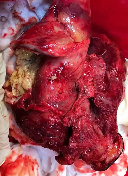 Figure 4. Postoperative photo of the case in Figure 3 demonstrating the chronic walled-off nature of the infection.