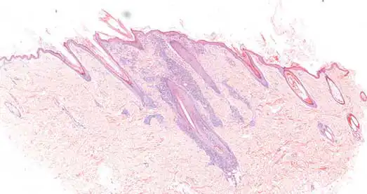 Figure 2. Skin. Superficial pyoderma and perifolliculitis. Superficial dermal chronic active inflammation, including perifollicular space.