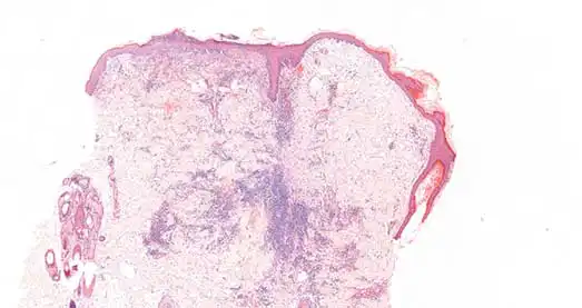 Figure 3. Skin. Superficial and deep pyoderma, superficial and deep dermal chronic active inflammation.