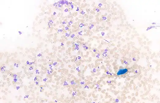 Figure 5. Fine-needle aspirate from a superficial pustule. Poorly and well-preserved neutrophils, with occasional intracytoplasmic coccoid bacteria, that are also often observed in extracellular space. We can also observe an anucleated squamous epithelial cell with attached cocci. These elements are in a background of small amounts of blood and fragmented cells.