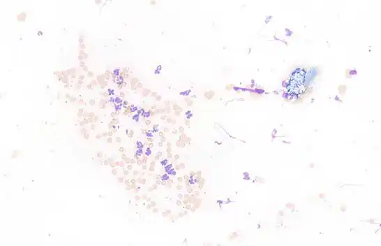 Figure 6. Fine-needle aspirate from a superficial pustule. Poorly and well-preserved neutrophils, with occasional intracytoplasmic coccoid bacteria, that are also often observed in extracellular space. We can also observe an anucleated squamous epithelial cell with attached cocci. These elements are in a background of small amounts of blood and fragmented cells.