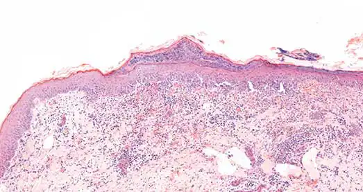 Figure 7. Skin. Superficial subcorneal pustule characterised by numerous mature and degenerated neutrophils, and cellular debris, in a background of amorphous eosinophilic material. The underlying dermis has mild to moderate inflammation composed of neutrophils and fewer lymphocytes, plasma cells and rare histiocytes.