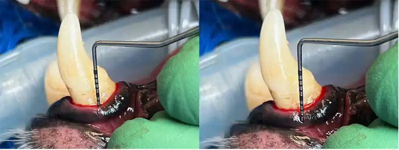 Figure 2. Photo showing assessment of the biologic width. The sulcus probes as 2mm and the total gingival height is 3mm, which means that the biologic width is less than 2mm.