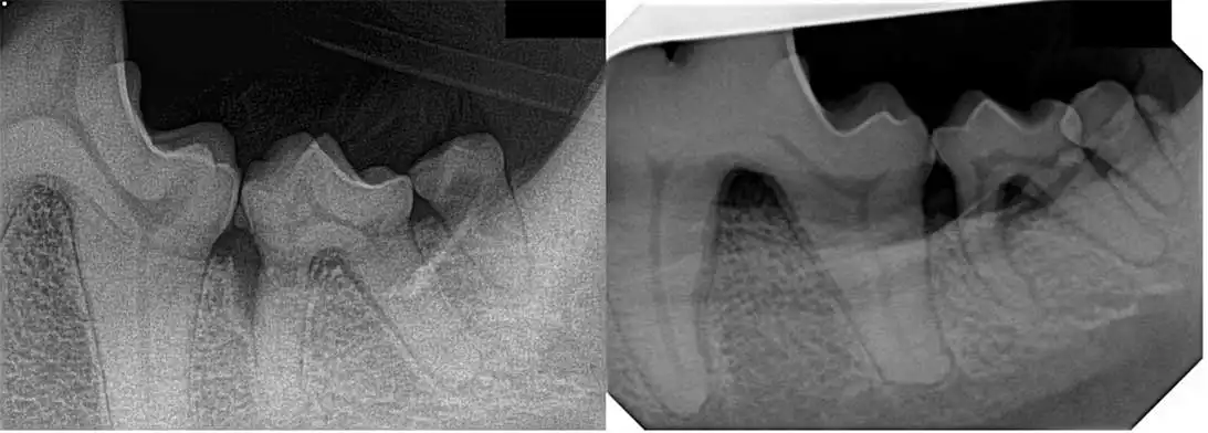 Figure 3. Radiograph of the left mandibular second molar tooth showing the difference between vertical alveolar bone loss (left) and horizontal bone loss (right).