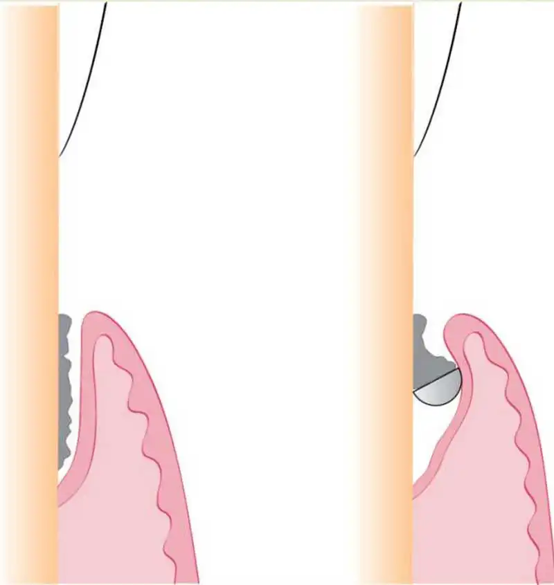 Figure 5. Diagram showing how the curette engages with the subgingival plaque (Newman, 2019).