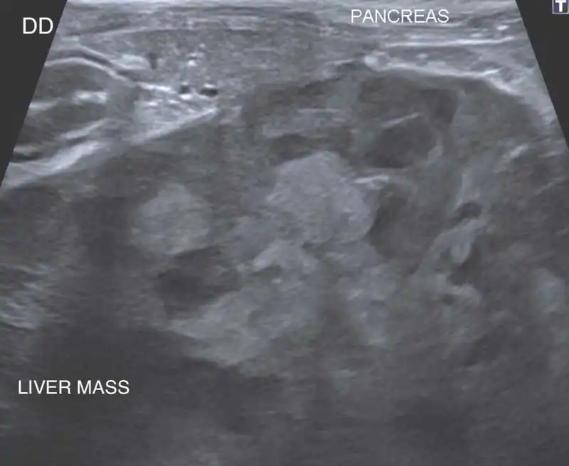 Figure 2. US scan showing a right liver mass, duodenum and pancreas.