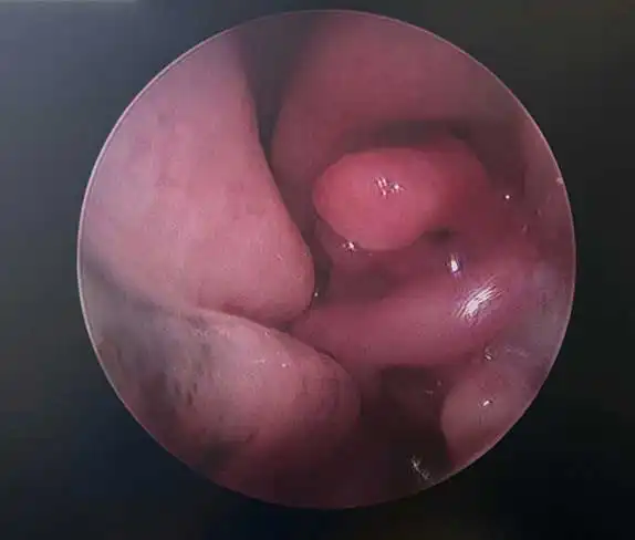 Figure 3. Pre-coblation nasal turbinates.