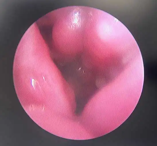 Figure 4. Post-coblation nasal turbinates.